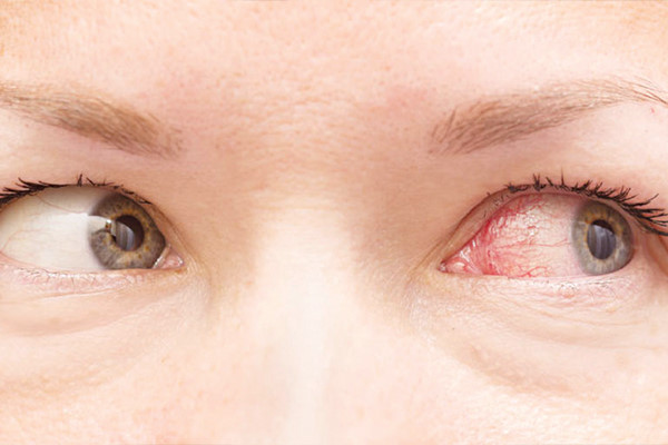 Nếu nhiễm trùng dài kỳ, kèm theo những căn bệnh vốn có có thể gây ảnh hưởng đến thị lực, thậm chí có thể dẫn đến mù lòa.