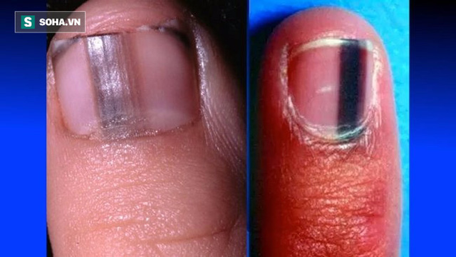Ngón tay trỏ và ngón chân cái thường là những ngón xuất hiện sọc đen hoặc nâu nhiều nhất